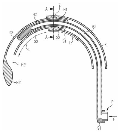 Teleskop-Katheteranordnung zur Therapie-Vorbereitung von Knorpel-Hyperplasien