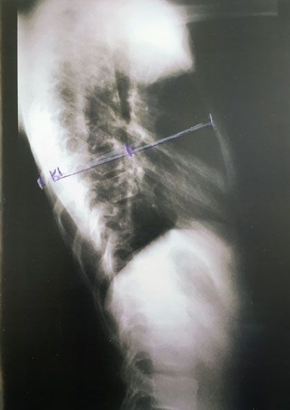 Messen des Thorax Tiefenparameters